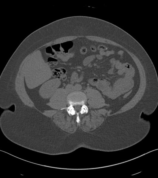 File:Calcified hepatic hydatid cyst (Radiopaedia 81127-94738 Axial non-contrast 58).jpg