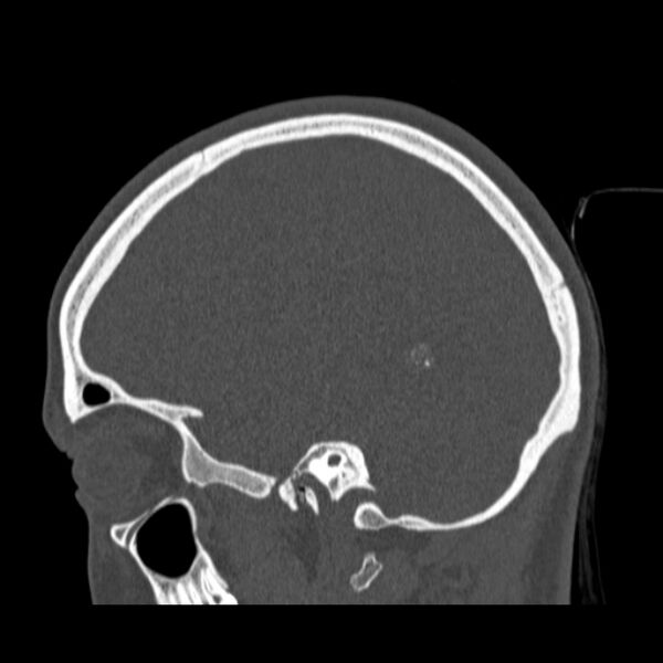 File:Calvarial osteoma (Radiopaedia 36520-38079 Sagittal bone window 74).jpg
