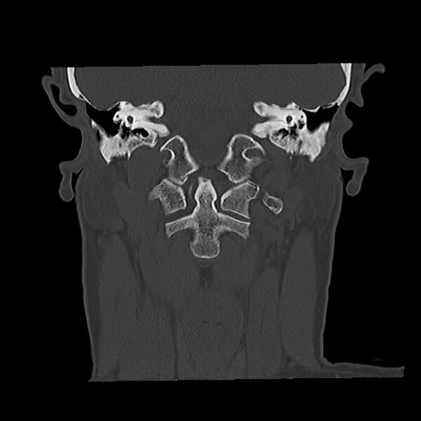 File:Canal up mastoidectomy (Radiopaedia 78108-90638 Coronal bone window 36).jpg