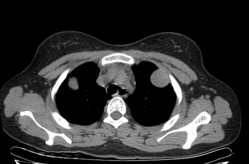 File:Cannonball metastases - uterine choriocarcinoma (Radiopaedia 70137-80173 Axial non-contrast 18).jpg
