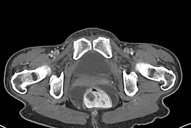 File:Carcinoid mesenteric tumor complicated by chylous ascites (Radiopaedia 76312-87953 A 80).jpg