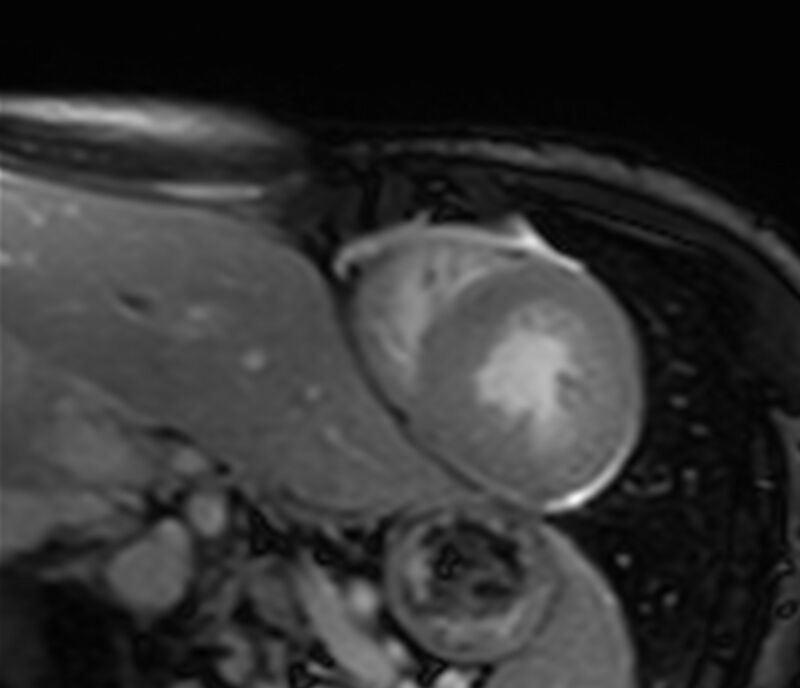 Cardiac amyloidosis (Radiopaedia 39736-42124 F 138).jpg