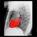 Cardiomediastinal anatomy on chest radiography (annotated images) (Radiopaedia 46331-50772 K 1).png