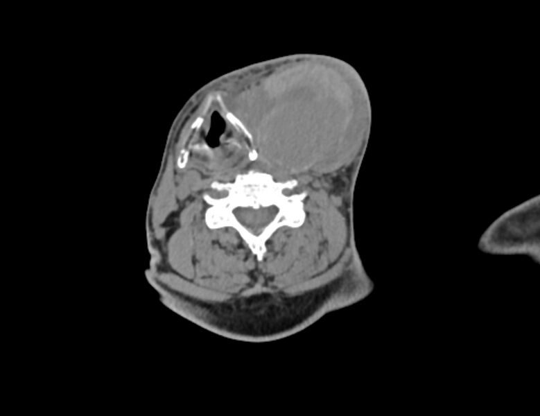 File:Carotid artery pseudoaneurysm (Radiopaedia 84030-99259 Axial non-contrast 31).jpg