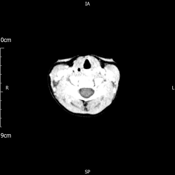 File:Cavernous sinus thrombosis (Radiopaedia 79414-92510 Axial Brain 1).jpg