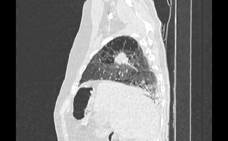 File:Cavitating bronchogenic carcinoma (Radiopaedia 44489-48162 Sagittal lung window 6).jpg