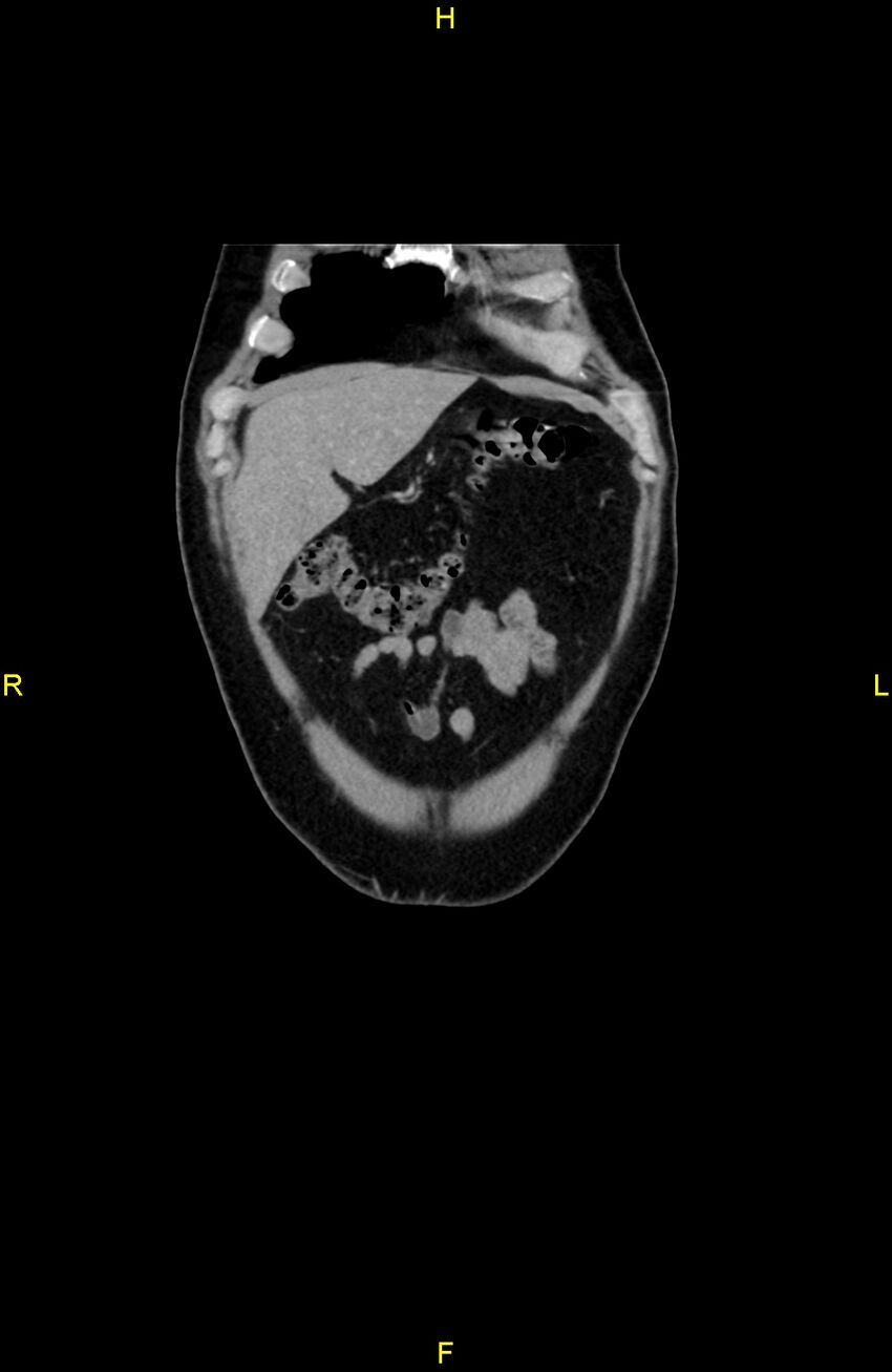 Cecal epiploic appendagitis (Radiopaedia 86047-102164 B 14).jpg