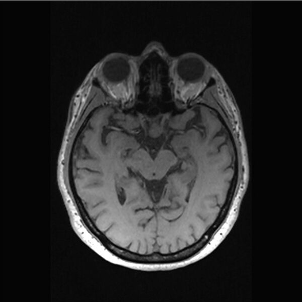 File:Central base of skull meningioma (Radiopaedia 53531-59549 Axial T1 25).jpg
