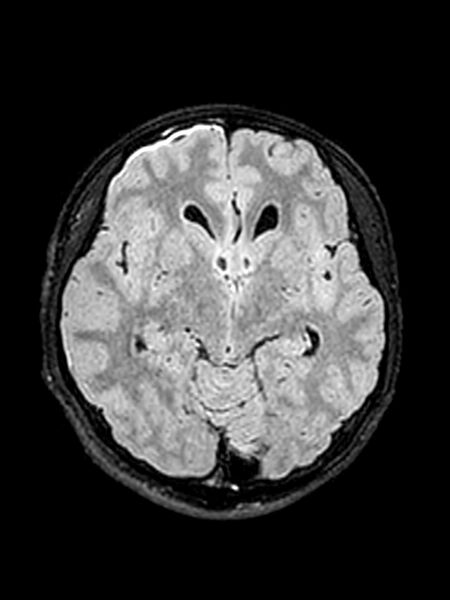File:Central neurocytoma (Radiopaedia 79320-92381 Axial FLAIR 99).jpg