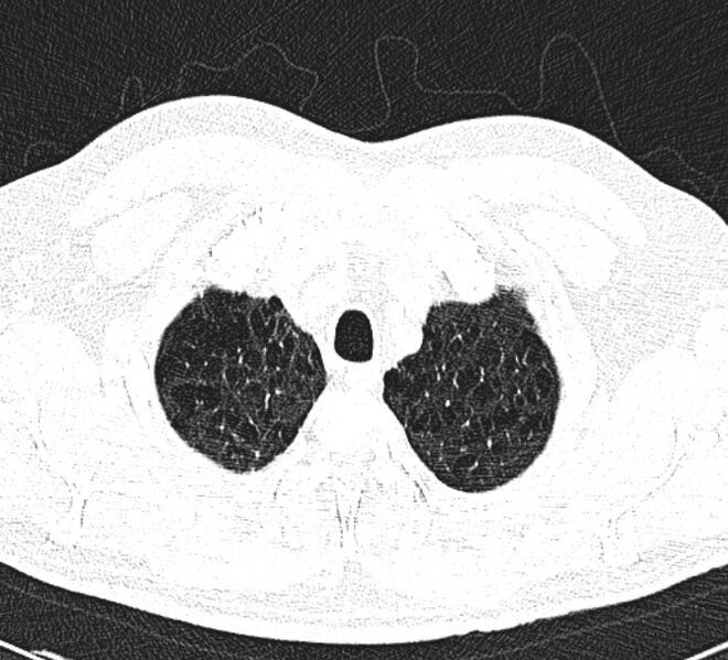 File:Centrilobular pulmonary emphysema (Radiopaedia 26808-26971 Axial lung window 5).jpg