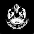 Cerebellar abscess secondary to mastoiditis (Radiopaedia 26284-26412 Axial non-contrast 2).jpg