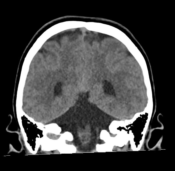 File:Cerebellar agenesis (Radiopaedia 30203-30817 Coronal non-contrast 31).jpg