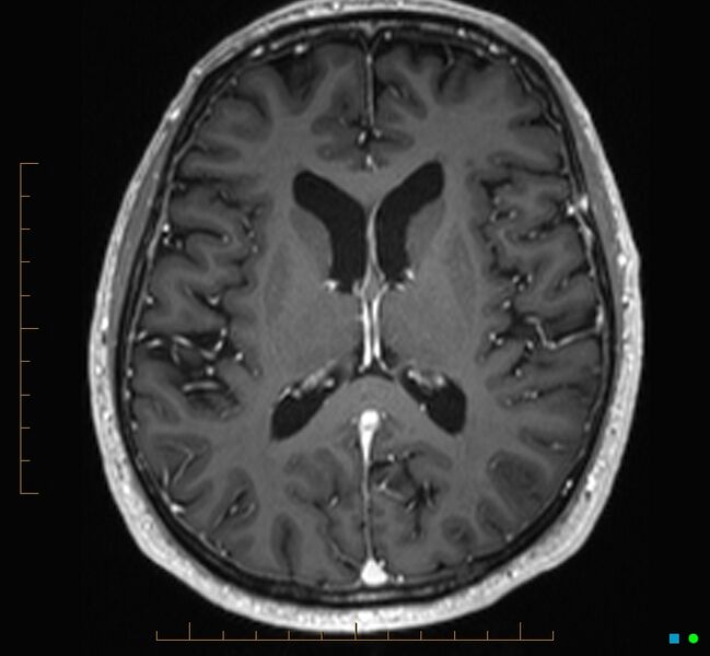 File:Cerebellar gangliocytoma (Radiopaedia 65377-74422 Axial T1 C+ 74).jpg