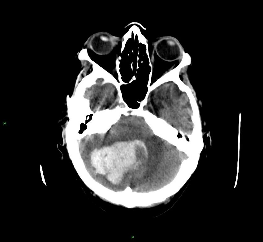 Cerebellar hemorrhage (Radiopaedia 58792-66026 Axial non-contrast 38).jpg