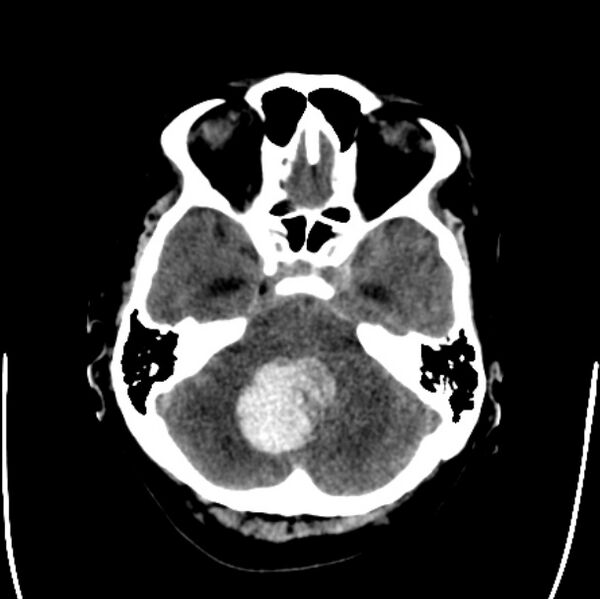 File:Cerebellar hemorrhage causing obstructive hydrocephalus (Radiopaedia 33989-35207 Axial non-contrast 13).jpg