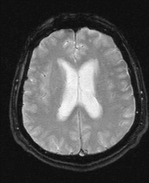 File:Cerebellopontine angle meningioma (Radiopaedia 24459-24764 Axial Gradient Echo 15).jpg