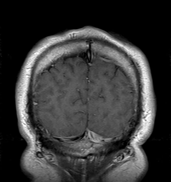 File:Cerebellopontine angle meningioma (Radiopaedia 24459-24764 Coronal T1 C+ 22).jpg