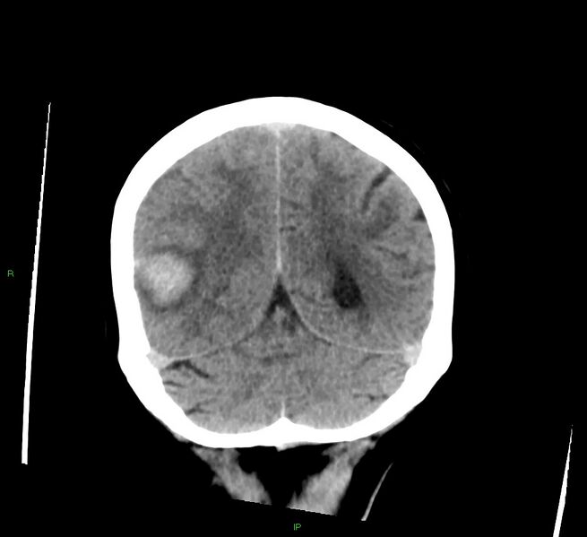 File:Cerebral amyloid angiopathy-associated lobar intracerebral hemorrhage (Radiopaedia 58378-65516 Coronal non-contrast 18).jpg