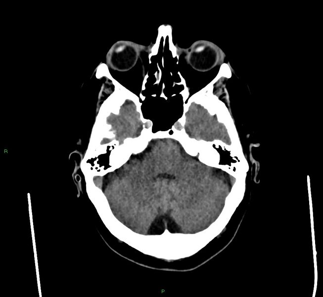 File:Cerebral amyloid angiopathy-associated lobar intracerebral hemorrhage (Radiopaedia 58560-65723 Axial non-contrast 40).jpg
