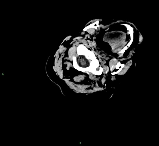 File:Cerebral amyloid angiopathy-associated lobar intracerebral hemorrhage (Radiopaedia 58757-65979 Axial non-contrast 4).jpg
