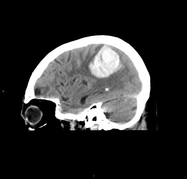 File:Cerebral amyloid angiopathy-associated lobar intracerebral hemorrhage (Radiopaedia 59356-66716 C 17).jpg