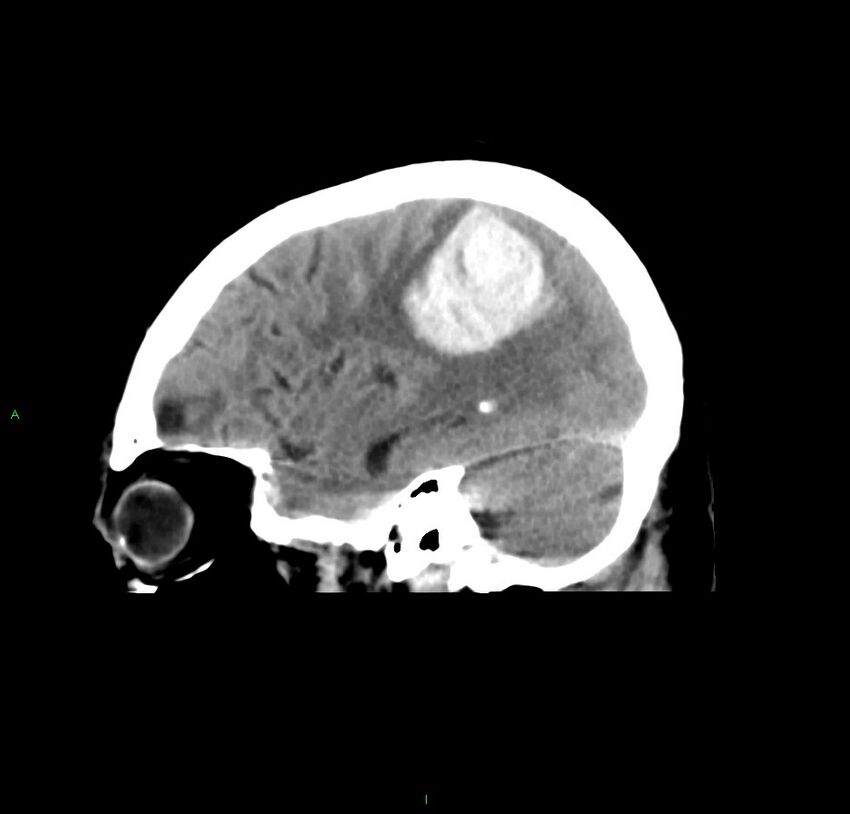 Cerebral amyloid angiopathy-associated lobar intracerebral hemorrhage (Radiopaedia 59356-66716 C 17).jpg