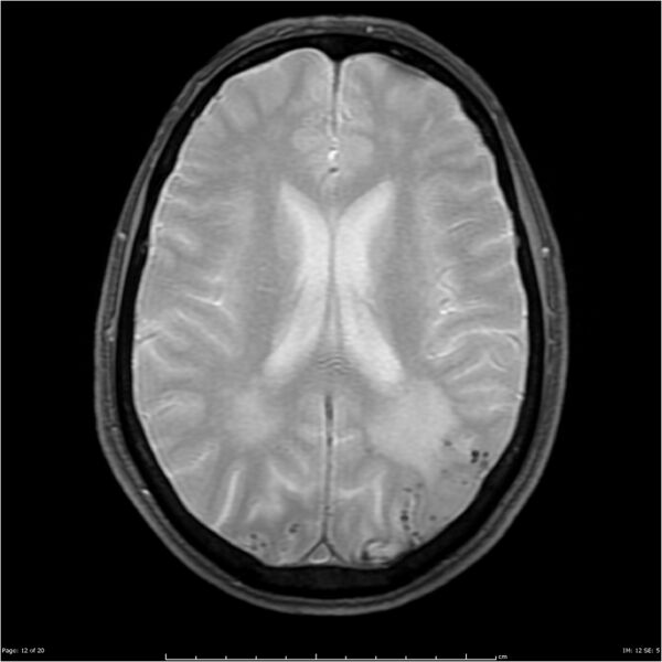 File:Cerebral amyloid angiopathy (Radiopaedia 4561-6683 Axial Gradient Echo 5).jpg