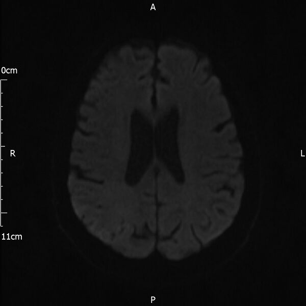 File:Cerebral amyloid angiopathy related inflammation (Radiopaedia 72772-83415 Axial DWI 61).jpg