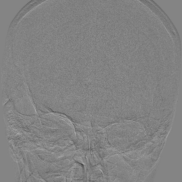 File:Cerebral aneurysm with rupture (Radiopaedia 29933-30458 LT ICA IC 4).jpg