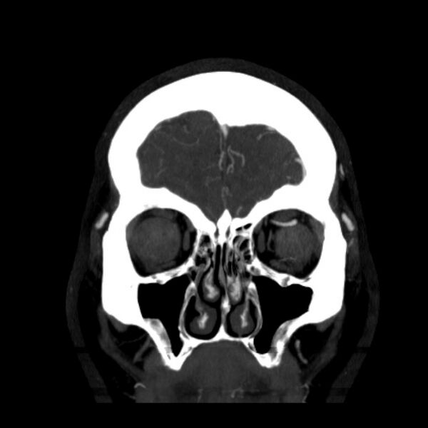 File:Cerebral arteriovenous malformation (Radiopaedia 43729-47189 C 6).jpg