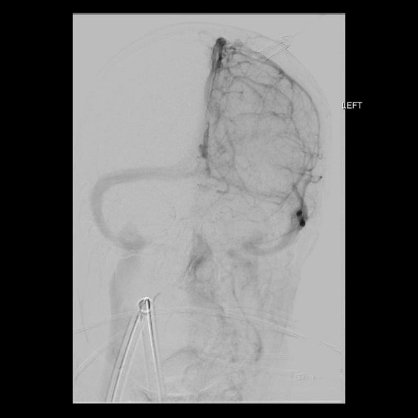File:Cerebral arteriovenous malformation with lobar hemorrhage (Radiopaedia 44725-48513 LT CCA IC 20).png