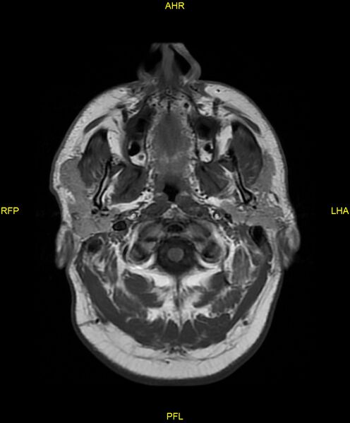File:Cerebral autosomal dominant arteriopathy with subcortical infarcts and leukoencephalopathy (CADASIL) (Radiopaedia 86108-102054 Axial T1 1).jpg