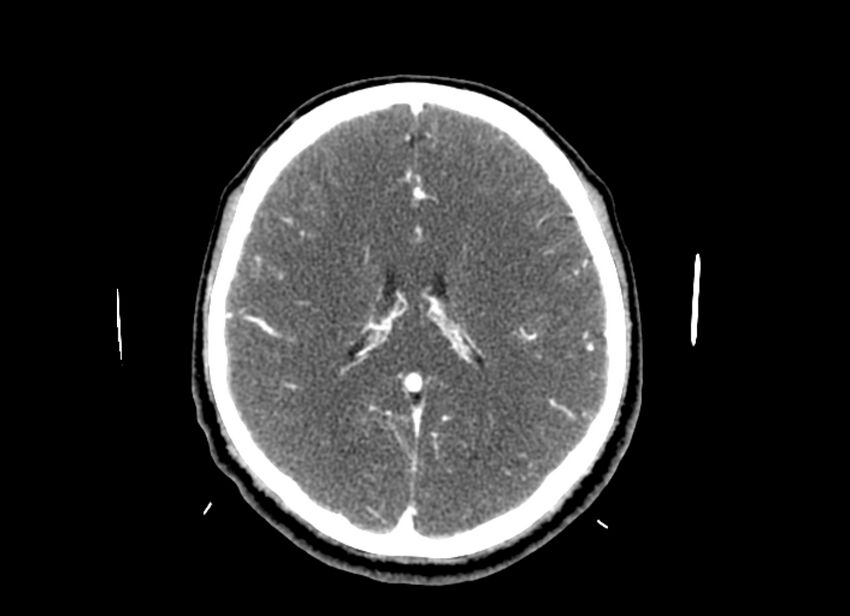 Cerebral edema (Radiopaedia 82519-96661 B 25).jpg