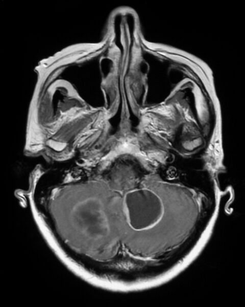 File:Cerebral metastases - small cell lung cancer (Radiopaedia 3972-6521 Axial T1 C+ 1).jpg