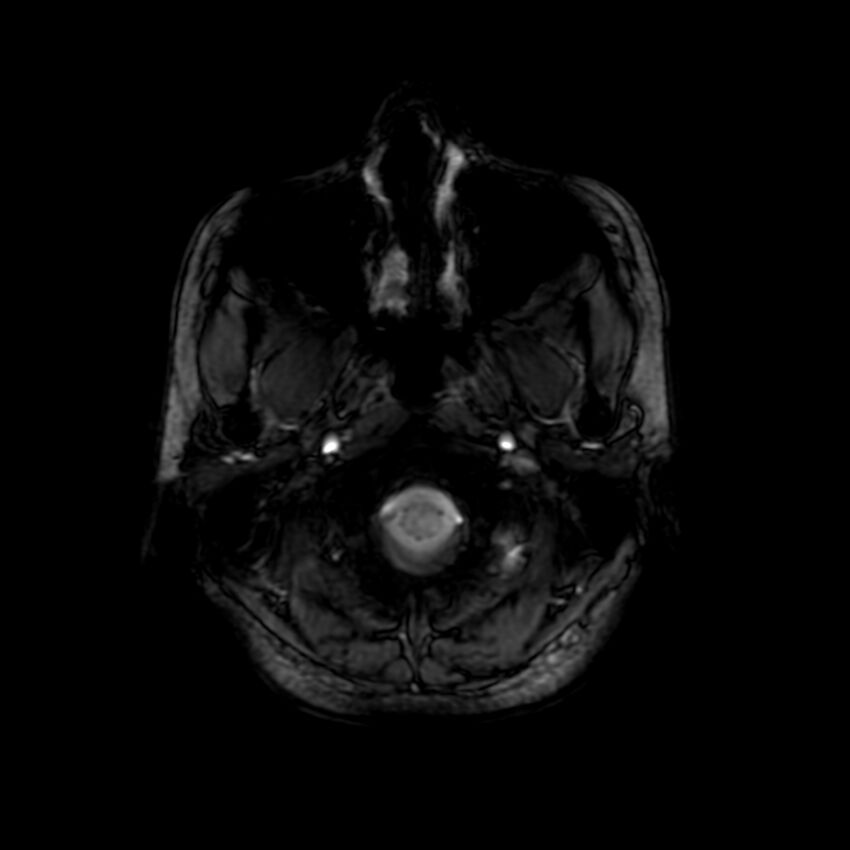 Cerebral paragonimiasis (Radiopaedia 73473-84238 Axial SWI 5).jpg