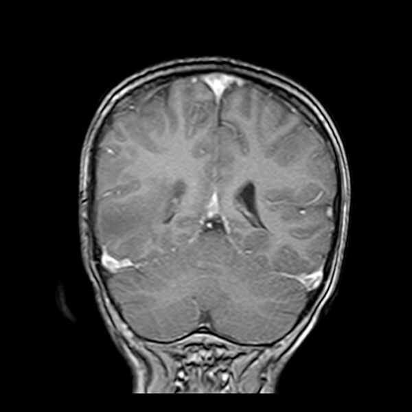 File:Cerebral tuberculoma (Radiopaedia 41152-43932 Coronal T1 C+ 15).jpg