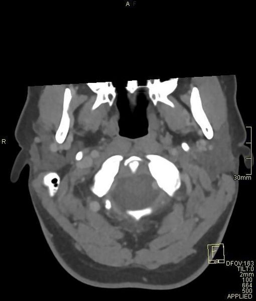 File:Cerebral venous sinus thrombosis (Radiopaedia 91329-108965 Axial venogram 8).jpg