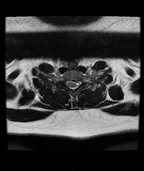 File:Cervical disc prolapse (Radiopaedia 80258-93598 Axial T2 66).jpg