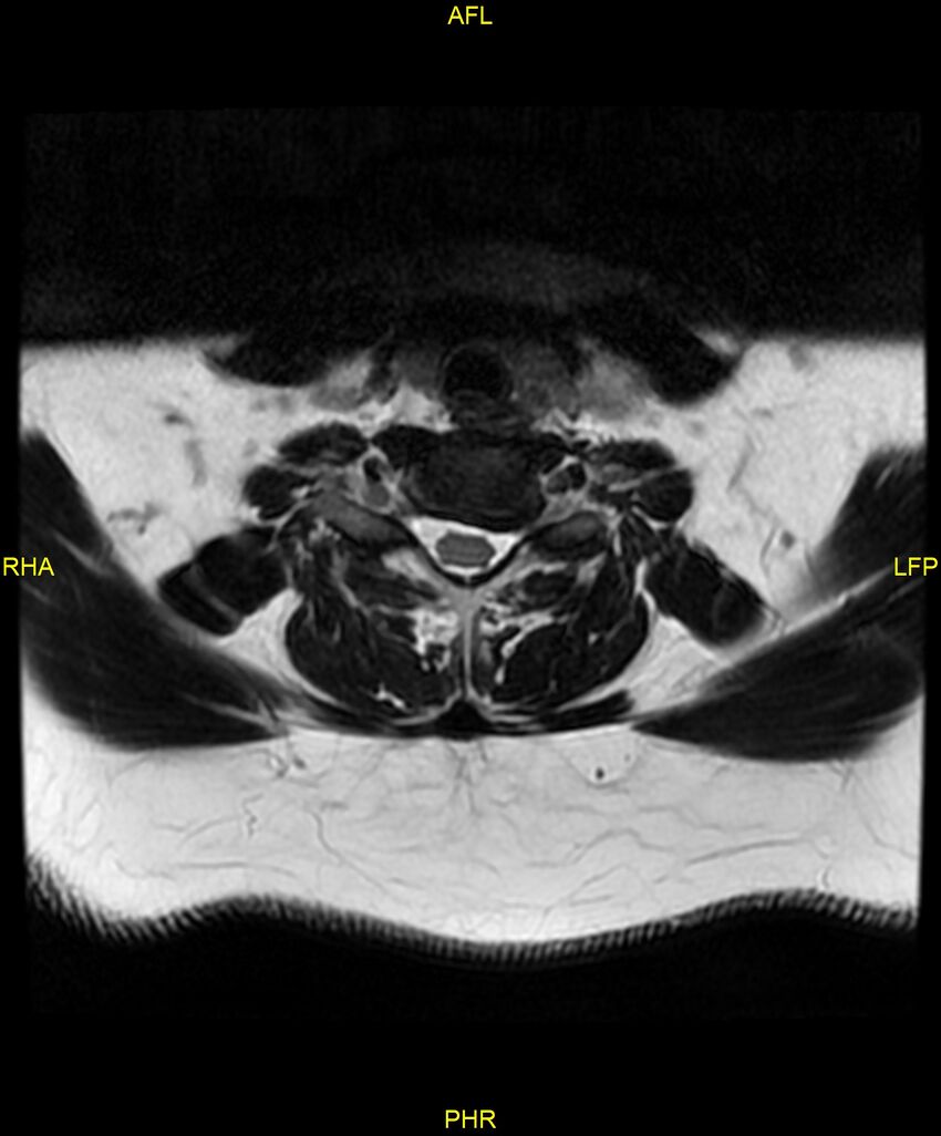 Cervical disc protrusion (Radiopaedia 87147-103415 Axial T2 52).jpg