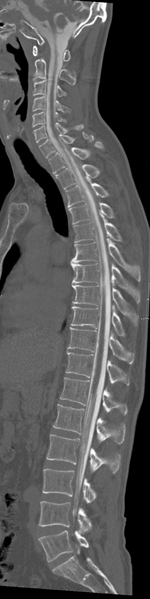 File:Cervical dural CSF leak on MRI and CT treated by blood patch (Radiopaedia 49748-54996 A 10).png