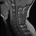Cervical flexion teardrop fracture with cord hemorrhage (Radiopaedia 32497-33455 Sagittal T1 8).jpg