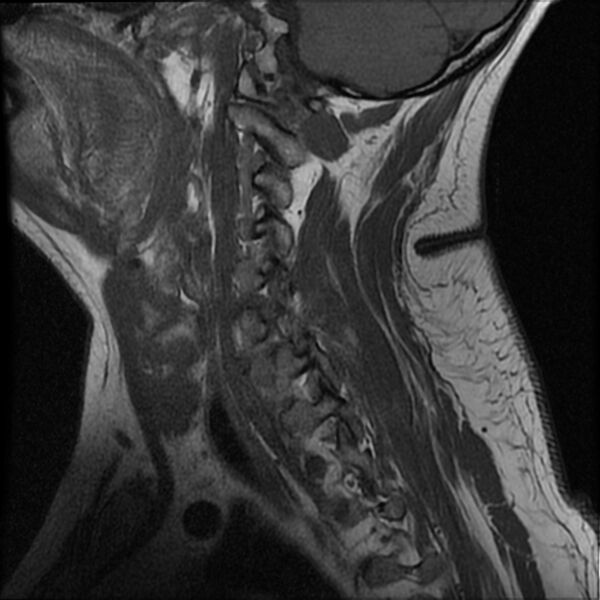 File:Cervical fracture and dislocation with locked facet (Radiopaedia 31837-32781 Sagittal T1 3).jpg