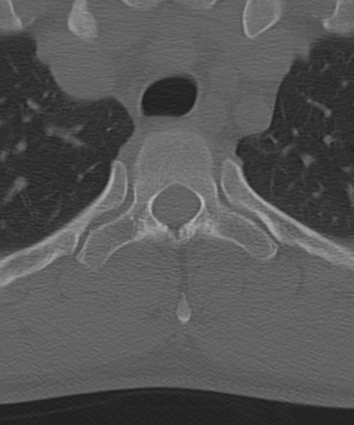 File:Cervical intercalary bone (Radiopaedia 35211-36748 Axial bone window 71).png