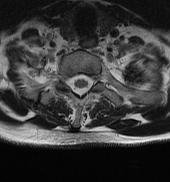 File:Cervical spondylodiscitis (Radiopaedia 81362-95110 Axial T2 20).jpg