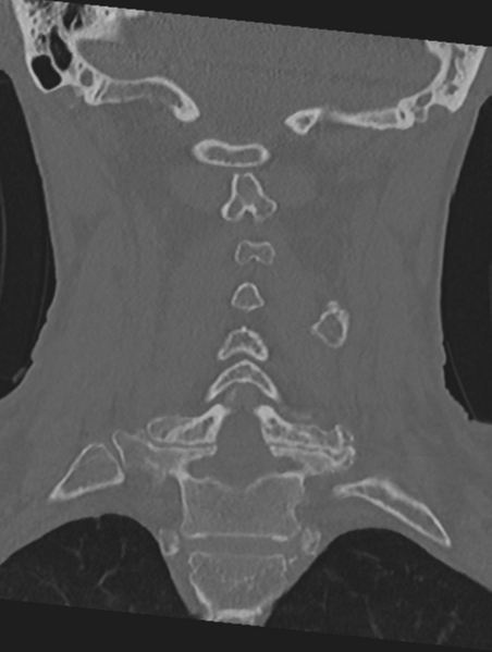 File:Cervical spondylolysis (Radiopaedia 49616-54811 Coronal bone window 32).png