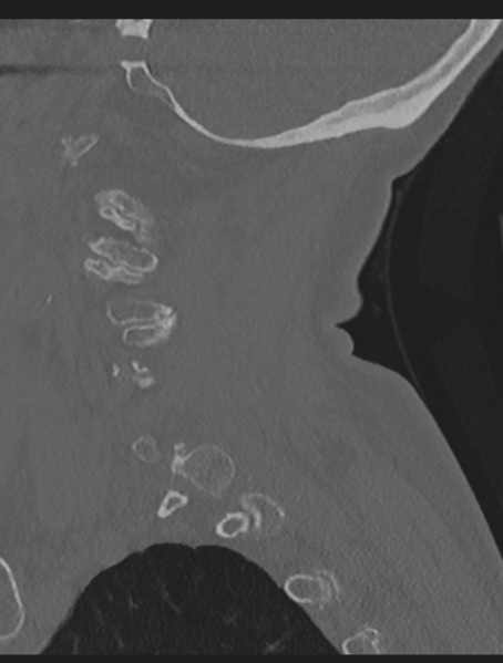File:Cervical spondylolysis (Radiopaedia 49616-54811 Sagittal bone window 17).png