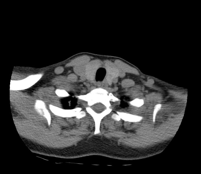 File:Cervical venous malformation (Radiopaedia 22653-22672 Axial non-contrast 46).jpg