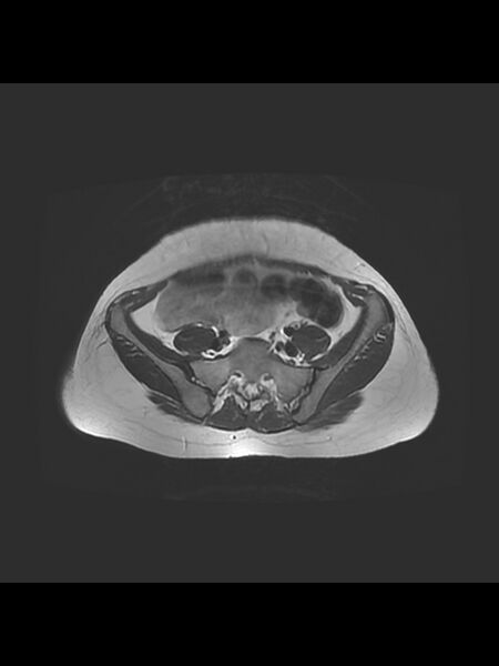 File:Cesarean section scar endometrioma (Radiopaedia 56569-63297 Axial T2 3).jpg