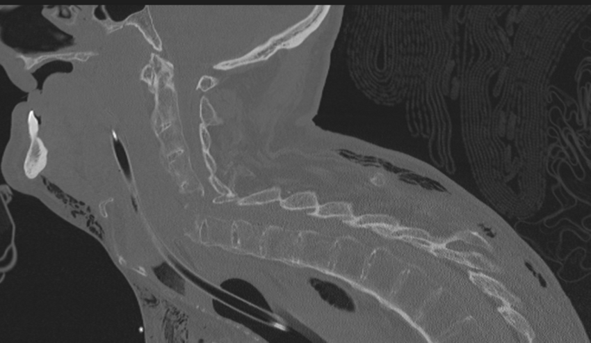 Chalk stick fracture (Radiopaedia 57948-64928 Sagittal bone window 35).png