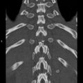 Chance fracture (Radiopaedia 36521-38081 Coronal bone window 50).jpg